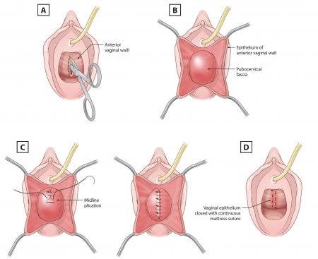 ap Vaginal repair hysterectomy