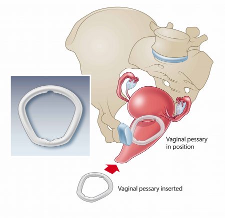 Non-surgical treatments for prolapse - Dr Marcus Carey