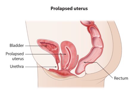 Prolapse of Vagina, Rectum or Uterus