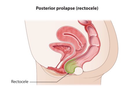 How to treat a prolapsed uterus and other pelvic organ prolapse