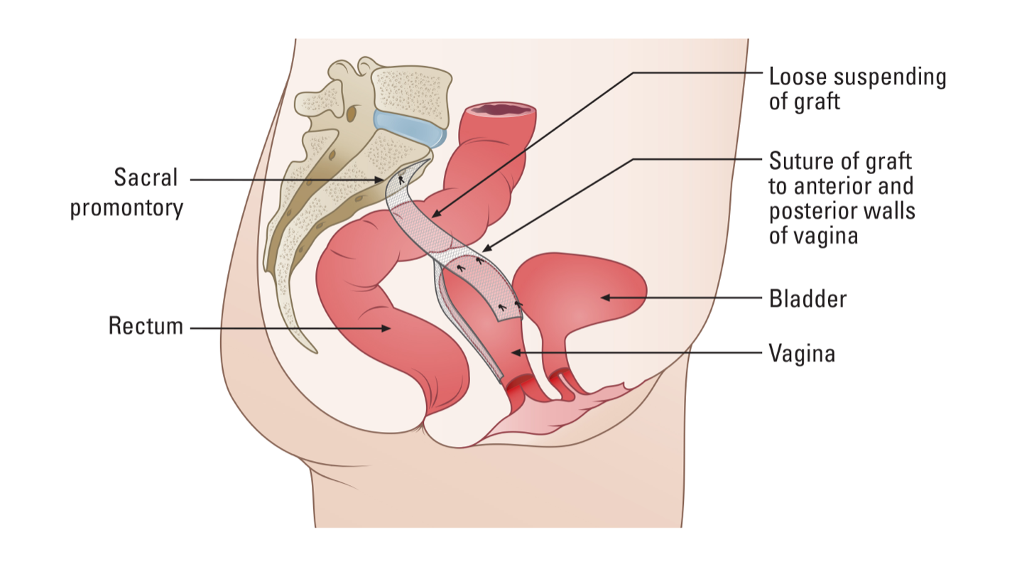 Robotic Assisted Sacrocolpopexy of Uterine and Vaginal Prolapse