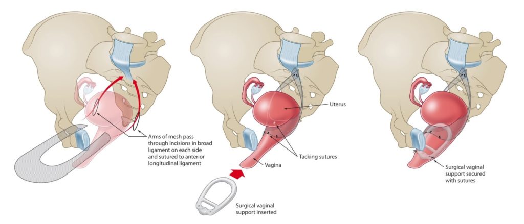 A Case of Laparoscopic Sacrohysteropexy: A Uterus Preserving