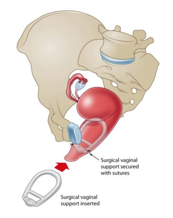 Surgical-Pelvic Organ Pessary (S-POP) - Dr Marcus Carey