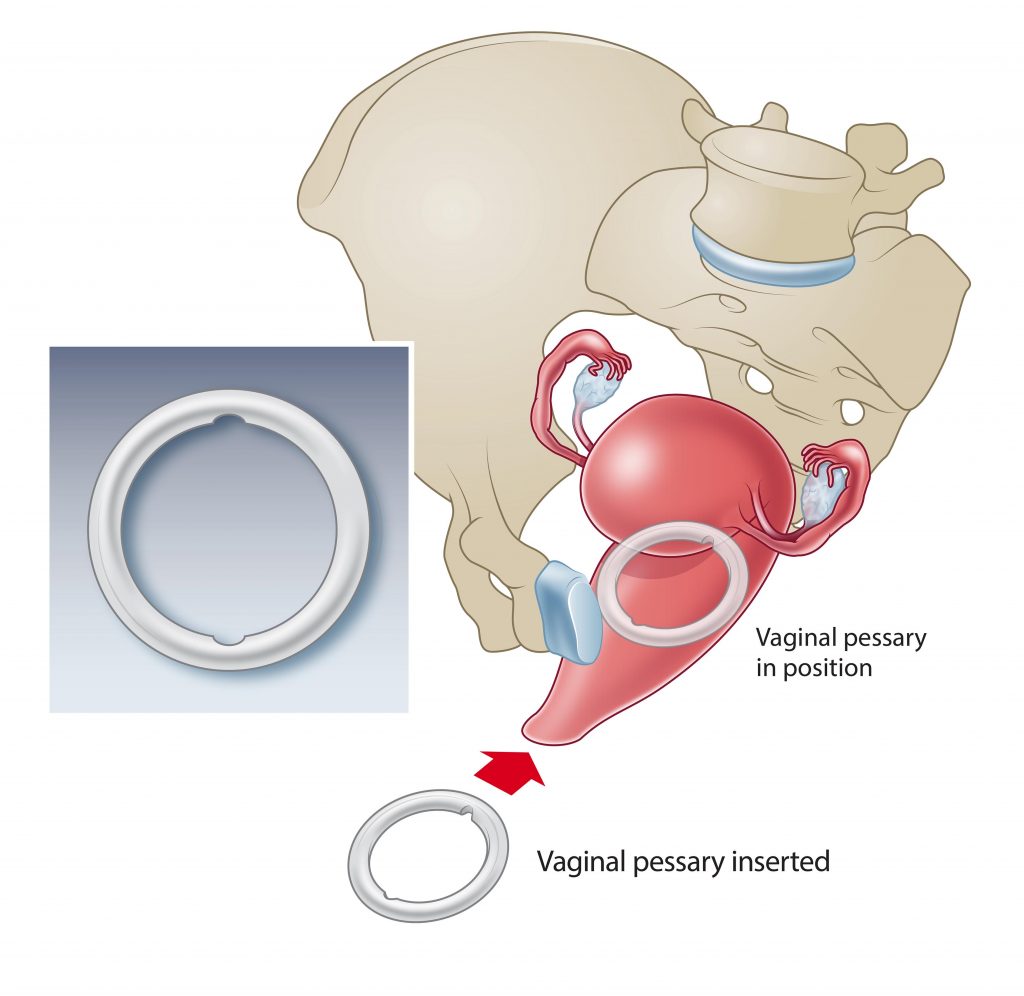 Weightlifter Rectal Prolapse