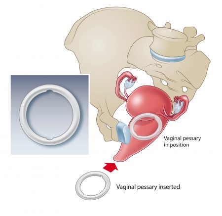 Pessary: Types and how to use