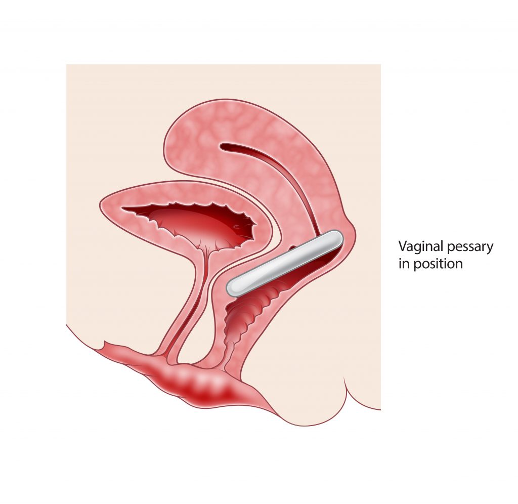 Prolapsed Bladder (Cystocele) Surgical Repair with a Vaginal Slin