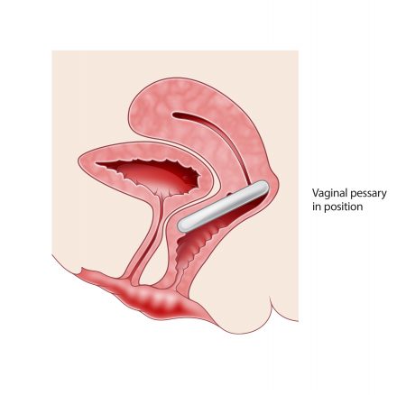 Uterine prolapse Information