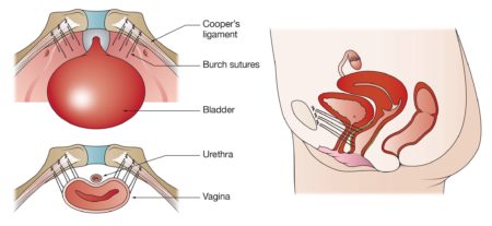 All pelvic floor surgery can be performed without mesh- UGSA 2018