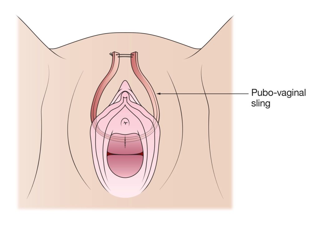 Transvaginal mesh