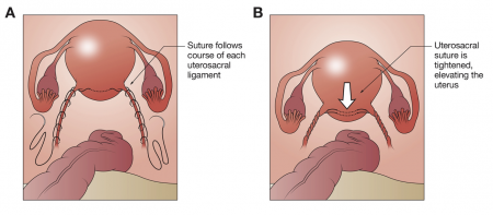 Pros & Cons of Pelvic Prolapse Surgery