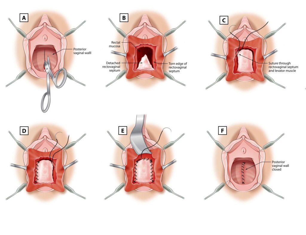 Vaginal Repair Dr Marcus Carey